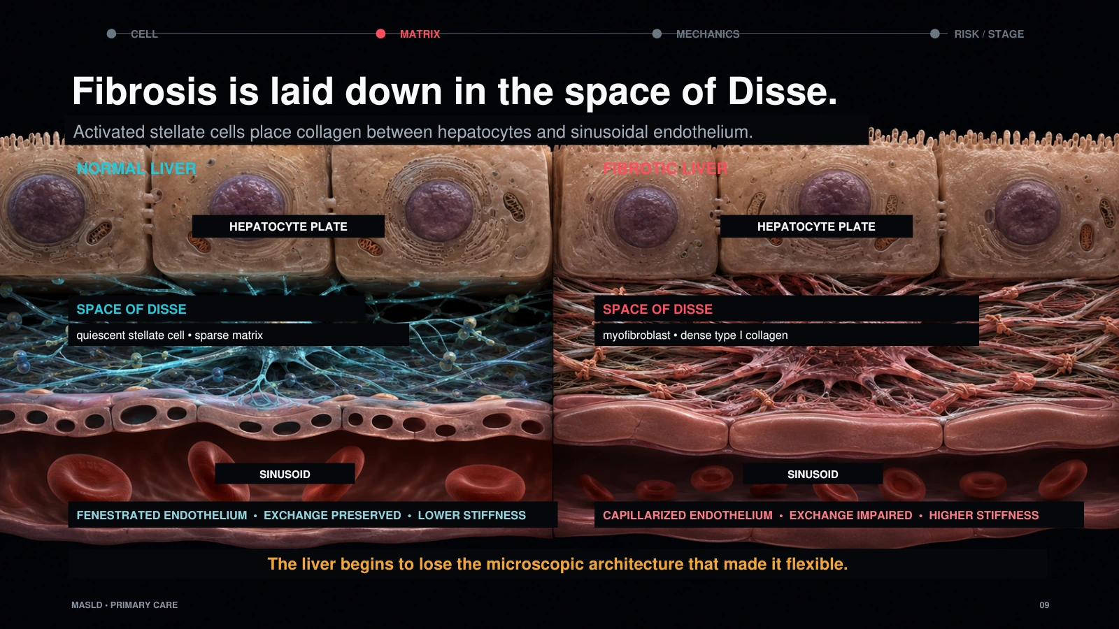 Slide 9: Fibrosis is laid down in the space of Disse.